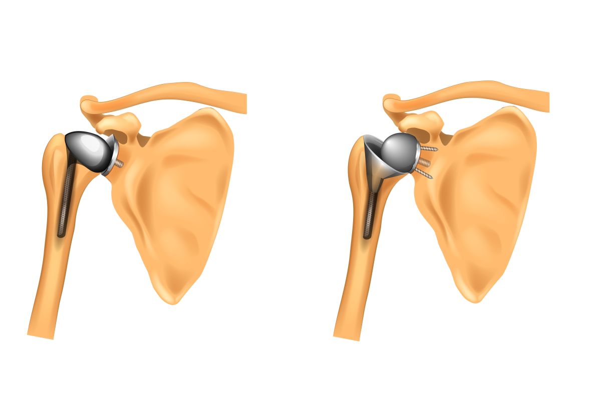 Prótesis de hombro: ¿Cuál es el tratamiento post-operatorio?