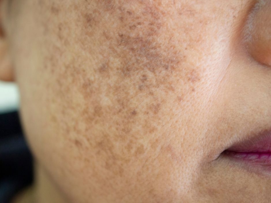crema para quitar manchas de la cara peru