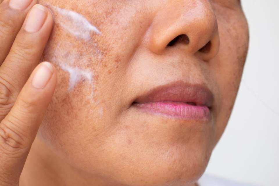 3 cremas que eliminan las manchas de la cara ocasionadas por la - La Opinión