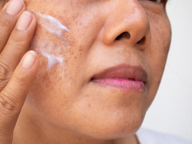 cremas eliminan las manchas de la cara por la menopausia - La Opinión