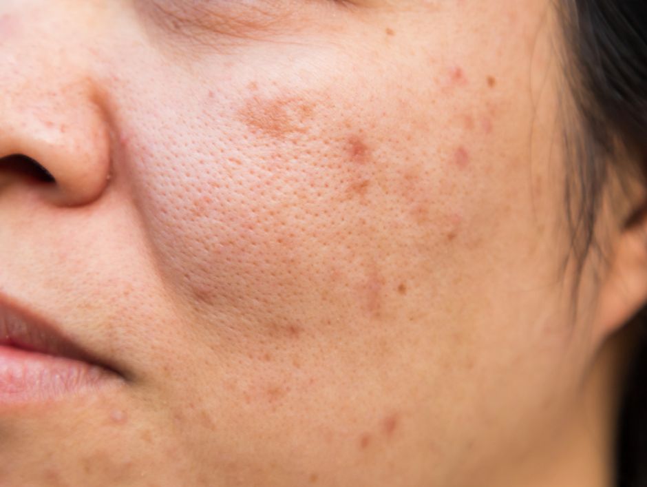 como quitar manchas negras de acne de la cara