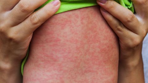 Un visitante llevó consigo la enfermedad altamente infecciosa durante visitas a lugares populares de Chicago.