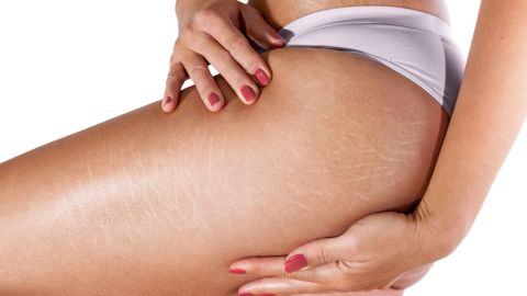 exfoliar estrías