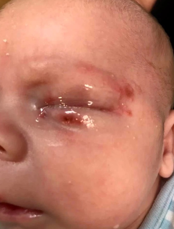 Bebe Contrae Herpes Por Un Beso En Su Bautizo La Opinion Bebe Contrae Herpes Por Un Beso En Su Bautizo La Opinion