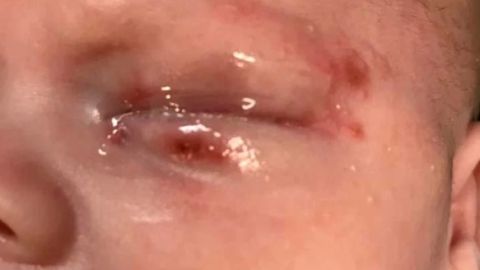 El niño fue contagiado del virus del herpes simple.