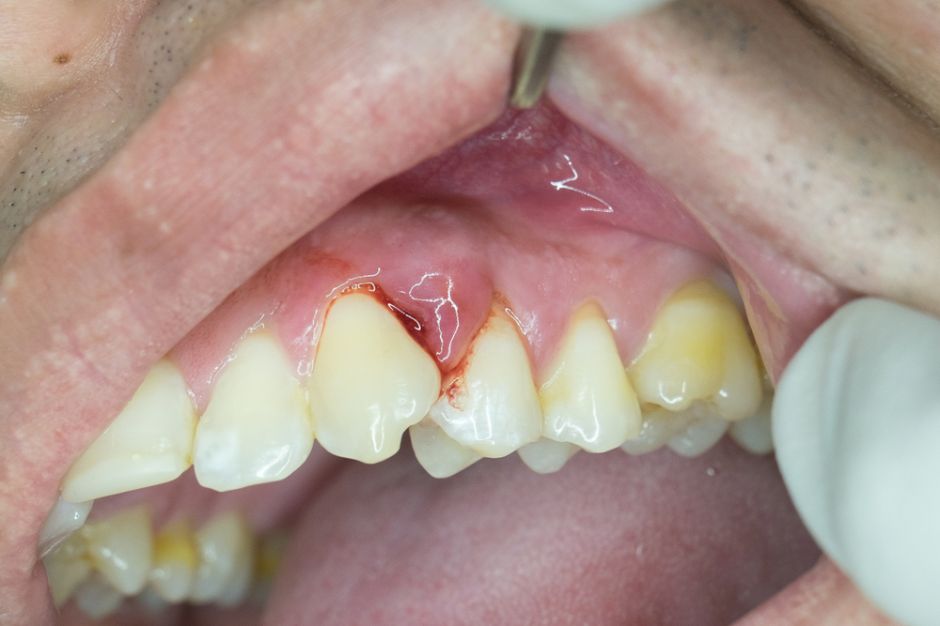 ¿Qué es la enfermedad periodontal y cuáles son sus causas para la salud