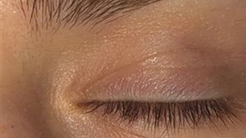 Gibson Miller antes y después de la cirugìa