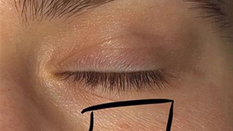 Gibson Miller antes y después de la cirugìa