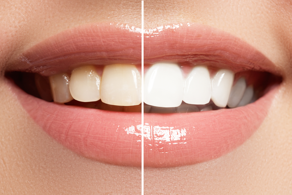 Blanqueamiento dental: ventajas vs. desventajas