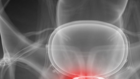 cancer-prostata