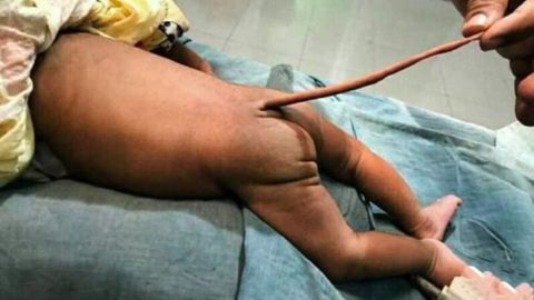 Bebé nació con una protuberancia llamada comúnmente "cola de ratón".