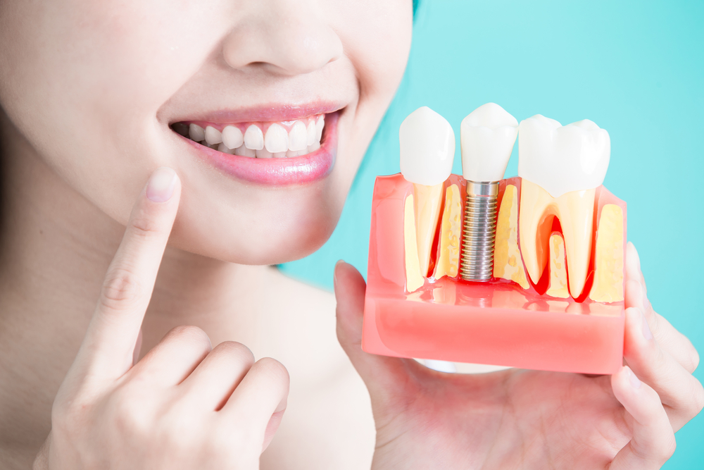 ¿Los implantes dentales son una solución efectiva?