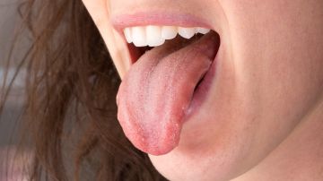 ránula lengua