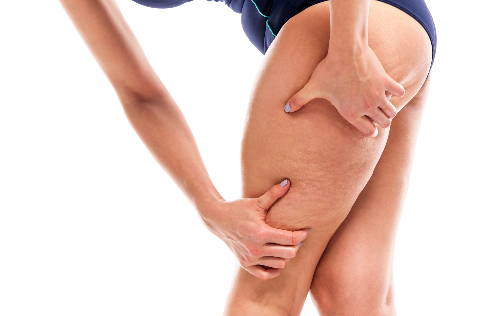 Los 5 mejores productos para eliminar la celulitis de tus piernas