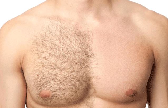 Depilación definitiva masculina: Métodos más recomendables para ...