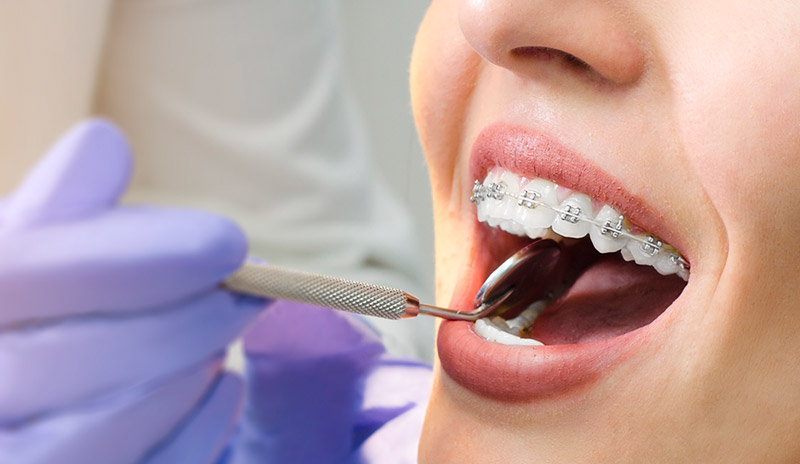 ¿Cuánto tiempo debería durar un tratamiento de ortodoncia en un adulto?