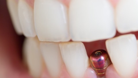 implante dental