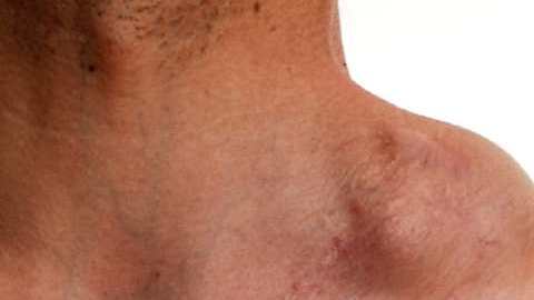 linfoma