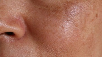melasma