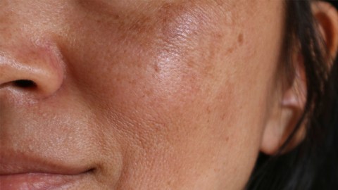 melasma