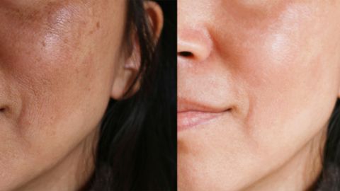 melasma