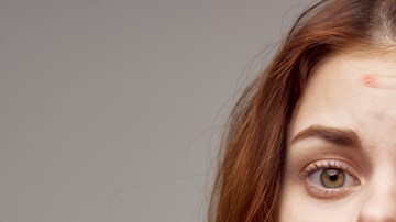 acné facial