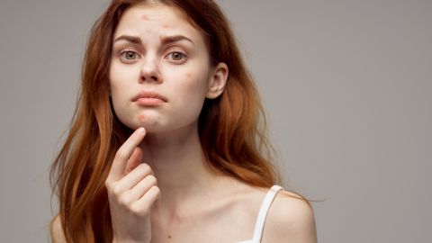 acné facial
