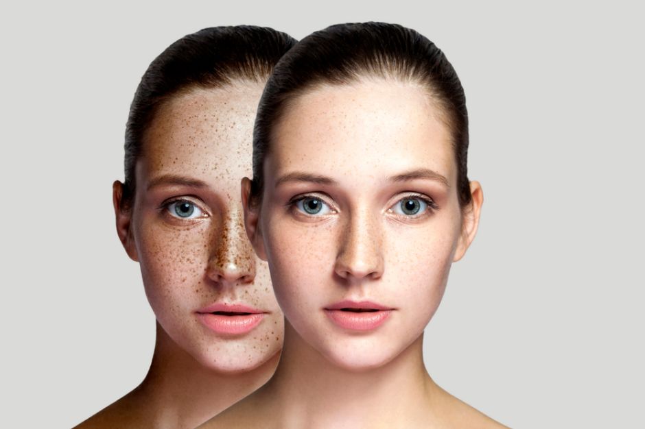 como quitar la melasma de la piel como quitar la melasma de la piel