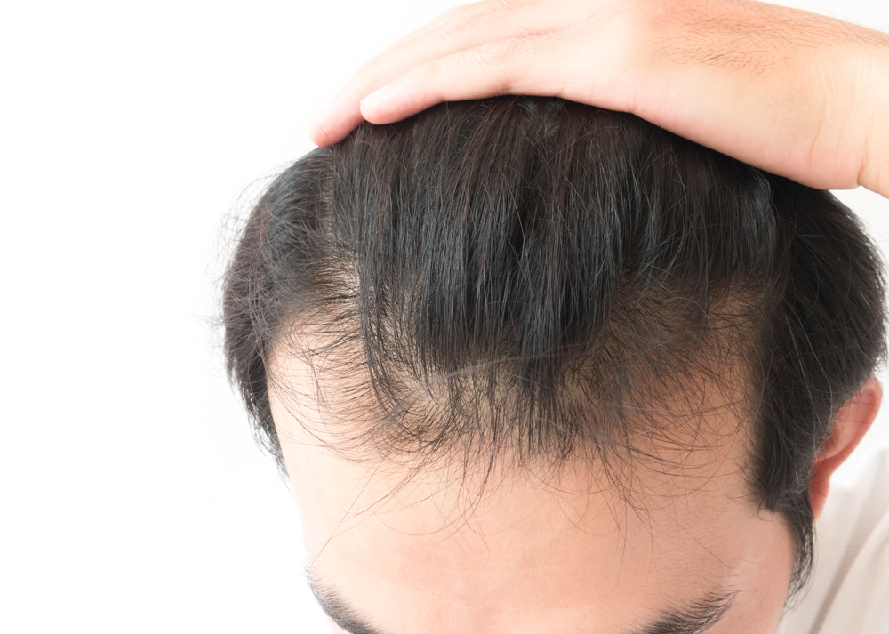 Cómo Fortalecer El Cuero Cabelludo Para Evitar Caída De Cabello La Opinión