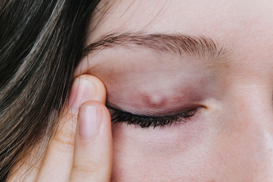 medicina para los orzuelos en los ojos medicina para los orzuelos en los ojos