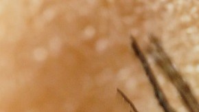 retinopatía diabética