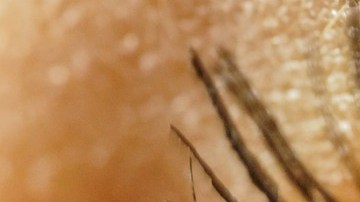 retinopatía diabética