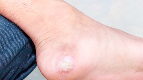 verrugas en los pies