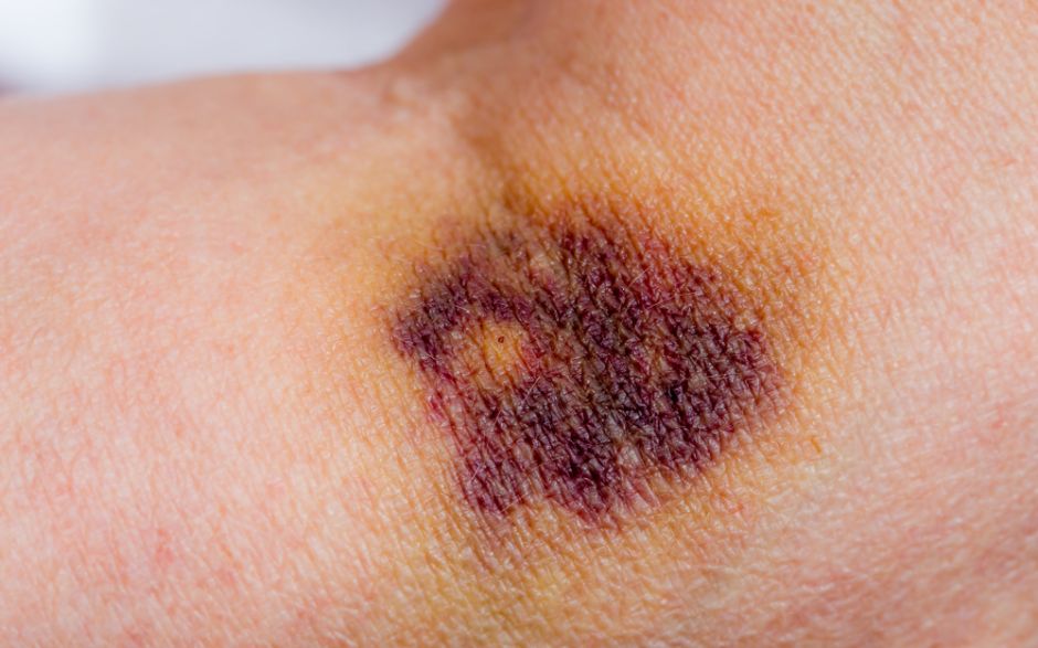 hematoma en la cara por golpe hematoma en la cara por golpe
