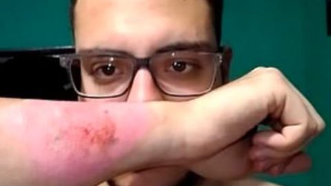 Así quedó su brazo después de eliminar el tatuaje