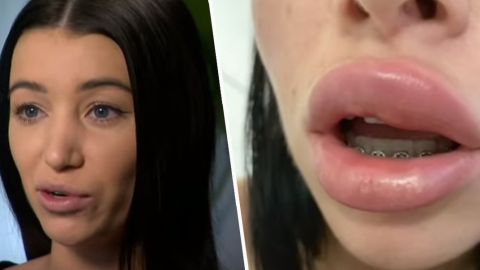 Mikayla Stutchbery casi queda ciega por los implantes labiales.