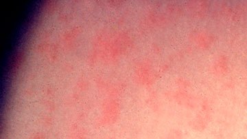 Todas las personas que estuvieron en el mismo lugar que este hombre, podrían enfermarse en los próximos 21 días.