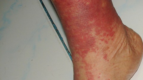 vasculitis