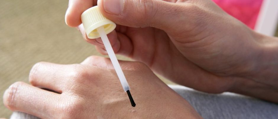 verrugas en los dedos en niños verrugas en los dedos en niños