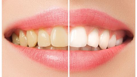 blanqueamiento dientes
