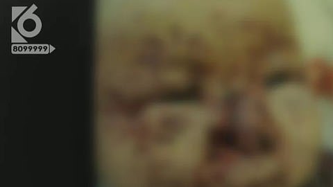 La bebé necesitará cirugías para reconstruirle el rostro.
