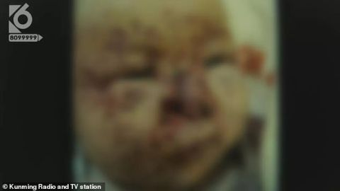 La bebé necesitará cirugías para reconstruirle el rostro.