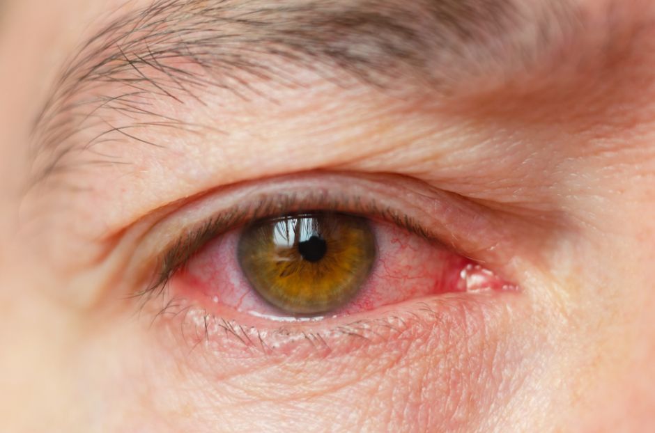 como limpiar los ojos cuando se tiene conjuntivitis como limpiar los ojos cuando se tiene conjuntivitis