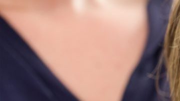 carillas dentales