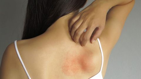 dermatitis