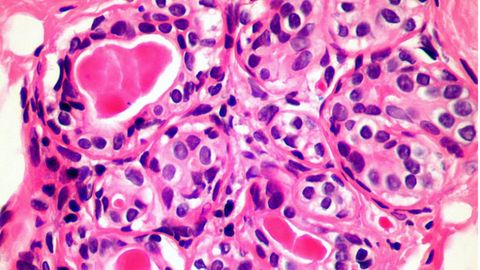 La nueva técnica podría matar una amplia gama de células cancerosas, incluidas las de mama y próstata.