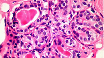 La nueva técnica podría matar una amplia gama de células cancerosas, incluidas las de mama y próstata.