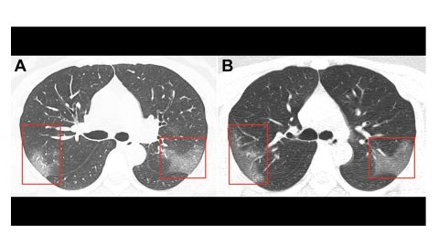 pulmones