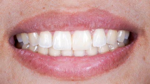 Un problema hormonal provoca esta extraña condición.