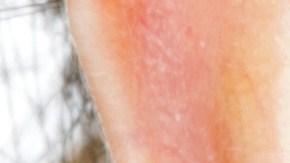 enfermedades-dermatologicas